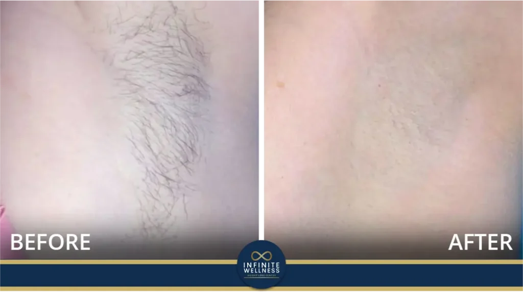Laser Hair Removal 21 Results of laser treatments