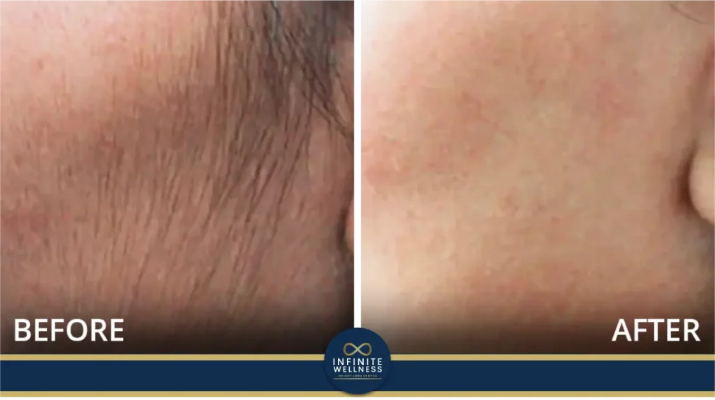 Laser Hair Removal 23 Results of laser treatments