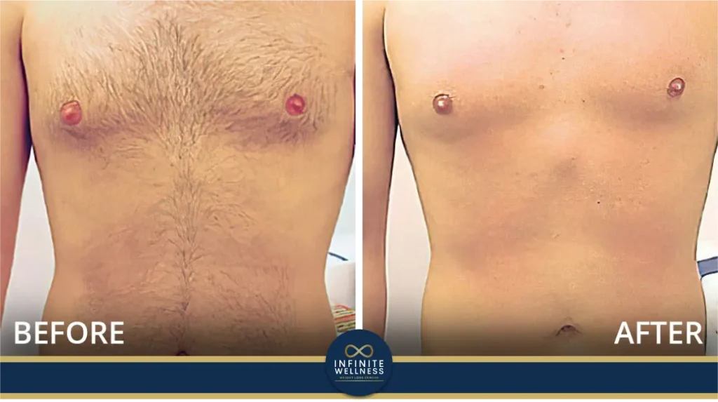 Laser Hair Removal 25 Results of laser treatments