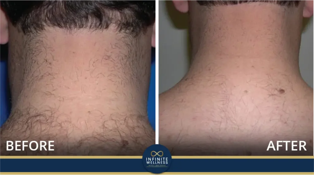 Laser Hair Removal 27 Results of laser treatments